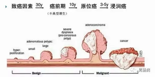 體檢查出腸息肉一定要切除！ 95%腸癌由它演變而來(lái)