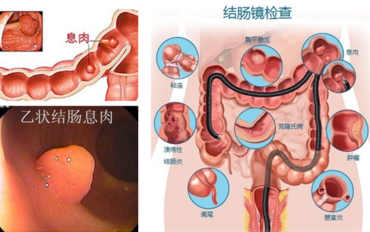 經(jīng)常放屁是在“排毒”？或許“根源”在腸道！