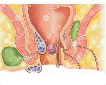 南寧哪個(gè)醫院可以做肛周膿腫？