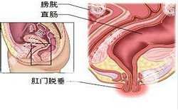 南寧治療脫肛哪家醫院好？南寧脫肛治療多少錢(qián)？